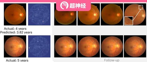 AI 辅助眼底疾病诊断:糖尿病视网膜病变识别率超 97%,基层医院可普及