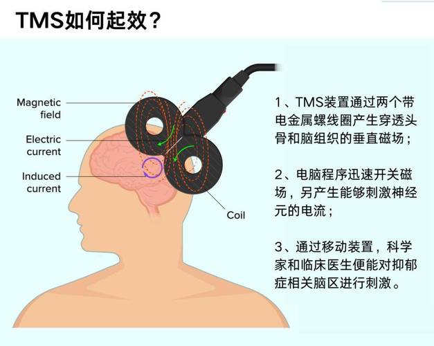 脑机接口 “抑郁症治疗”:经颅磁刺激 + 脑电波反馈,症状缓解率超 80%
